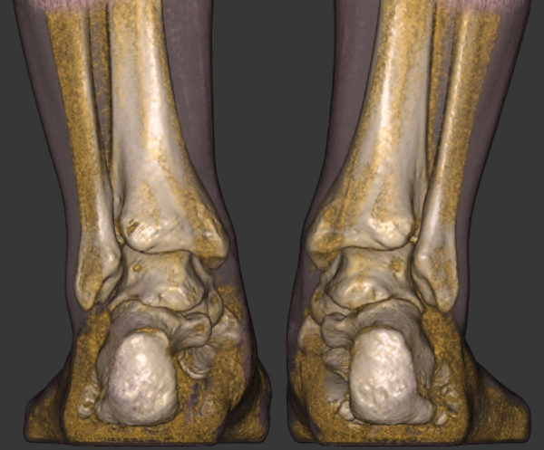 Weight Bearing CT Scanner - Atlantic Orthopaedic Specialists